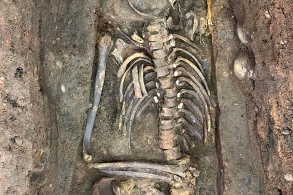 Anatomical dissection of adult male individual with circumferential craniotomy, removal of left arm and left pelvis, and displacement of left leg